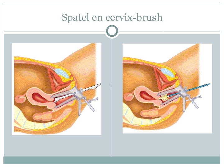 Spatel en cervix-brush 