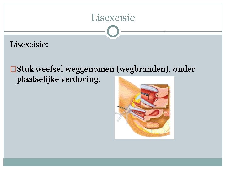 Lisexcisie: �Stuk weefsel weggenomen (wegbranden), onder plaatselijke verdoving. 