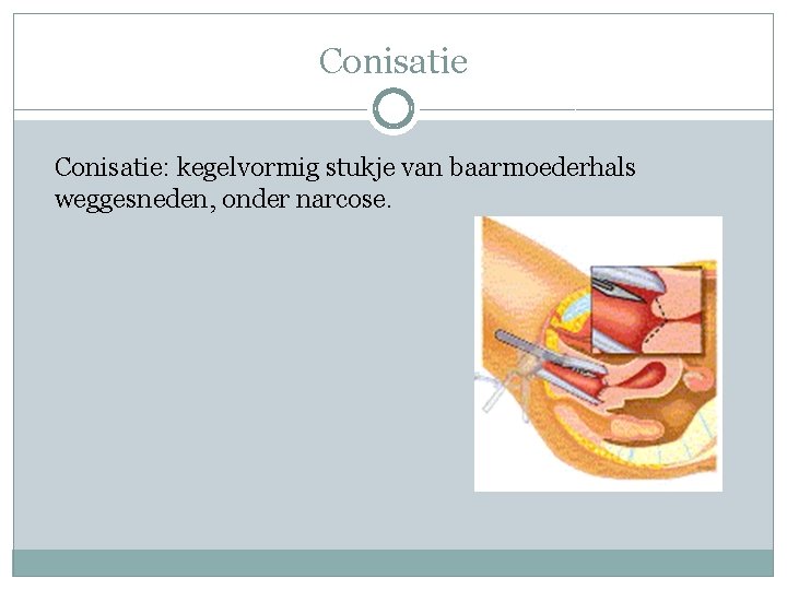 Conisatie: kegelvormig stukje van baarmoederhals weggesneden, onder narcose. 