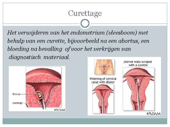 Curettage Het verwijderen van het endometrium (vleesboom) met behulp van een curette, bijvoorbeeld na