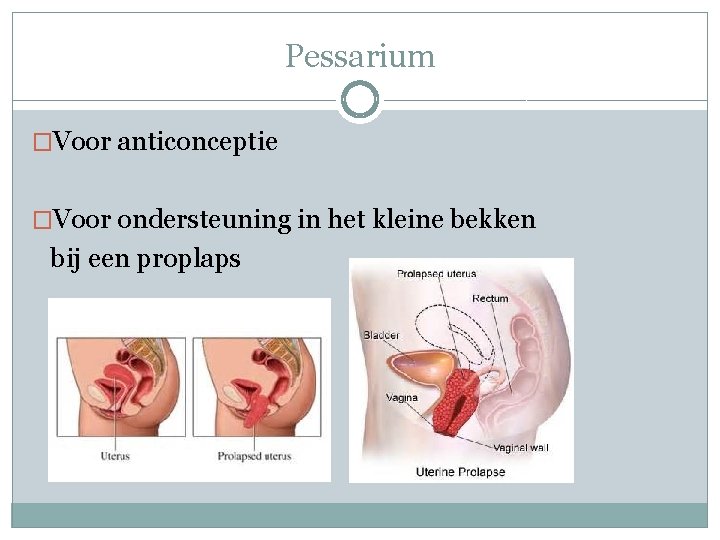 Pessarium �Voor anticonceptie �Voor ondersteuning in het kleine bekken bij een proplaps 