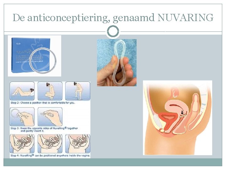 De anticonceptiering, genaamd NUVARING 