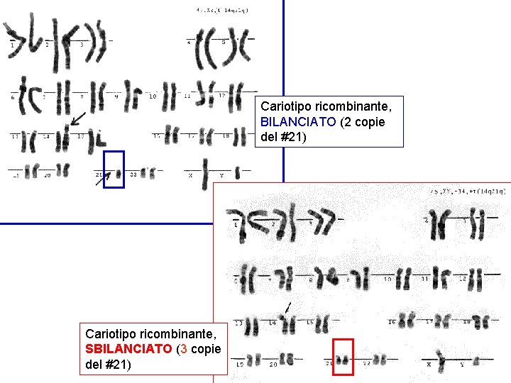 Cariotipo ricombinante, BILANCIATO (2 copie del #21) Cariotipo ricombinante, SBILANCIATO (3 copie del #21)