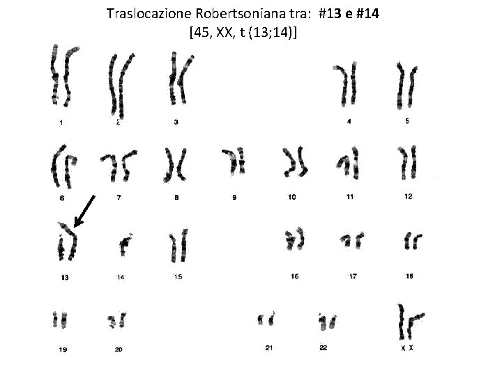 Traslocazione Robertsoniana tra: #13 e #14 [45, XX, t (13; 14)] 