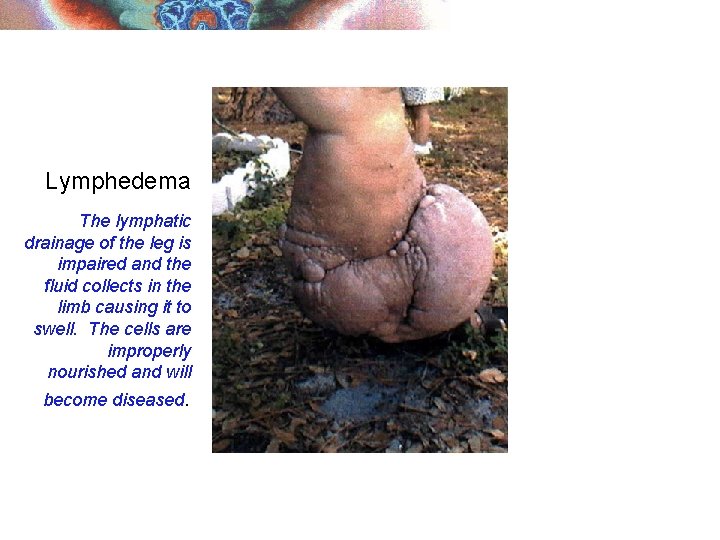 Lymphedema The lymphatic drainage of the leg is impaired and the fluid collects in