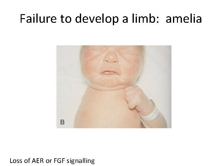 Failure to develop a limb: amelia Loss of AER or FGF signalling 