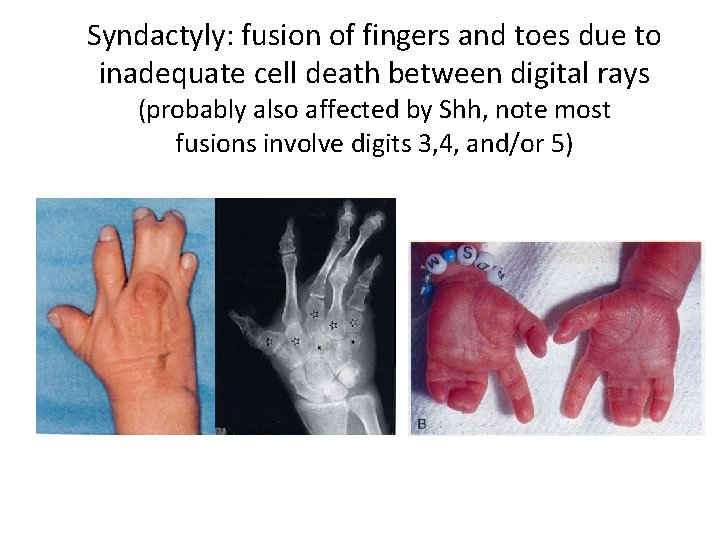 Syndactyly: fusion of fingers and toes due to inadequate cell death between digital rays