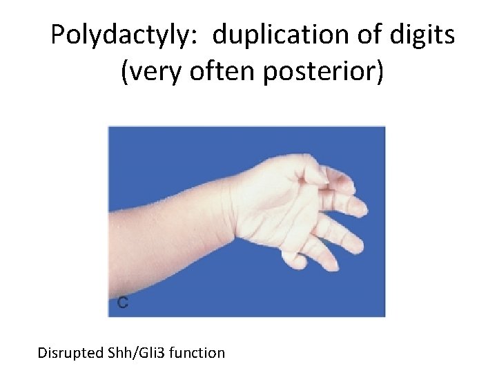Polydactyly: duplication of digits (very often posterior) Disrupted Shh/Gli 3 function 