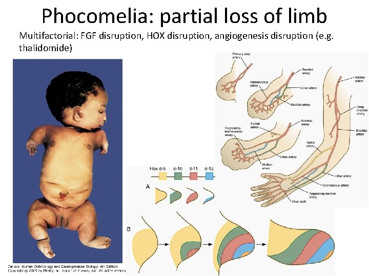 Phocomelia: partial loss of limb Multifactorial: FGF disruption, HOX disruption, angiogenesis disruption (e. g.