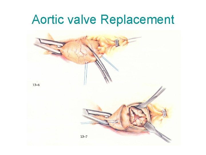 Aortic valve Replacement 