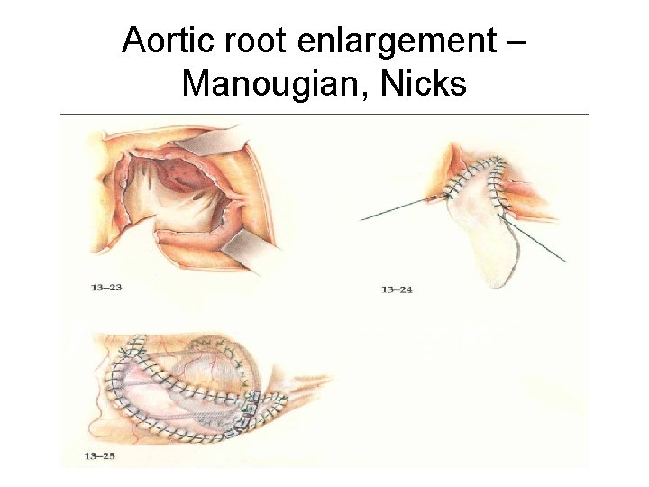 Aortic root enlargement – Manougian, Nicks 