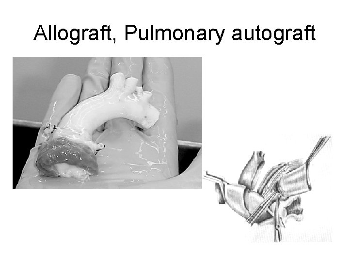 Allograft, Pulmonary autograft 