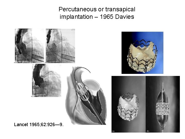 Percutaneous or transapical implantation – 1965 Davies Lancet 1965; 62: 926— 9. 