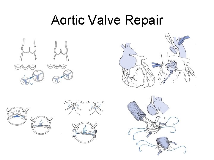 Aortic Valve Repair 