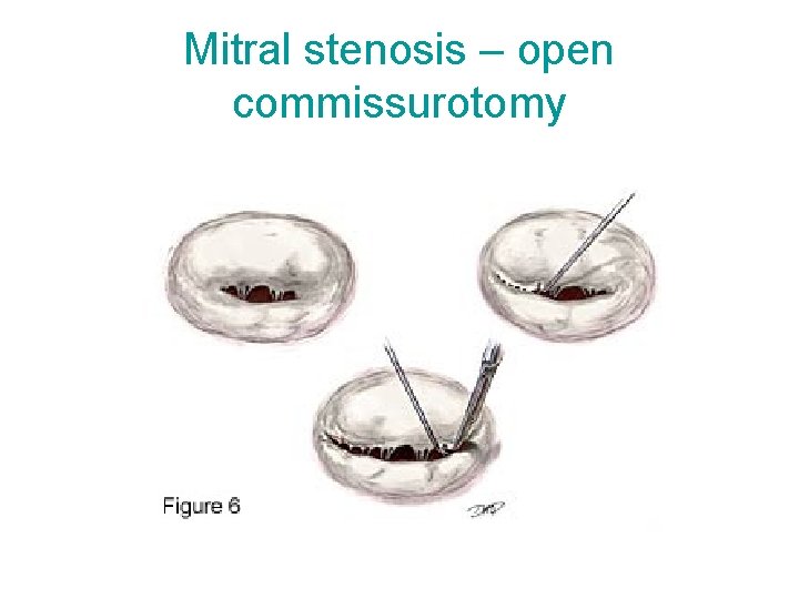 Mitral stenosis – open commissurotomy 