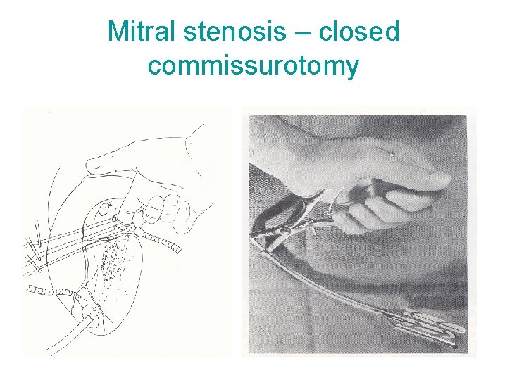 Mitral stenosis – closed commissurotomy 