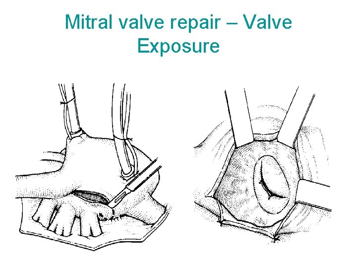 Mitral valve repair – Valve Exposure 