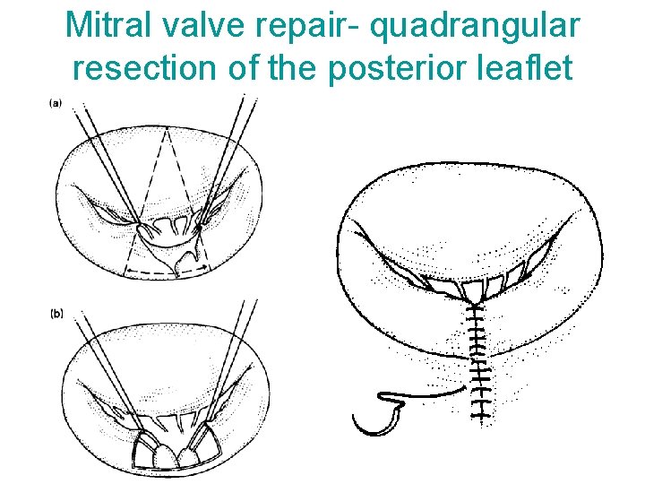 Mitral valve repair- quadrangular resection of the posterior leaflet 