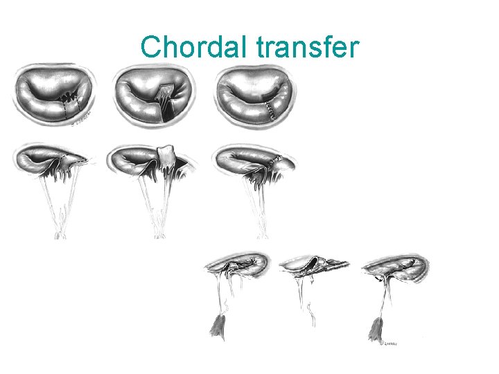 Chordal transfer 