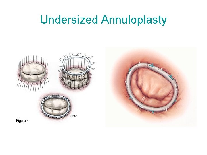 Undersized Annuloplasty 