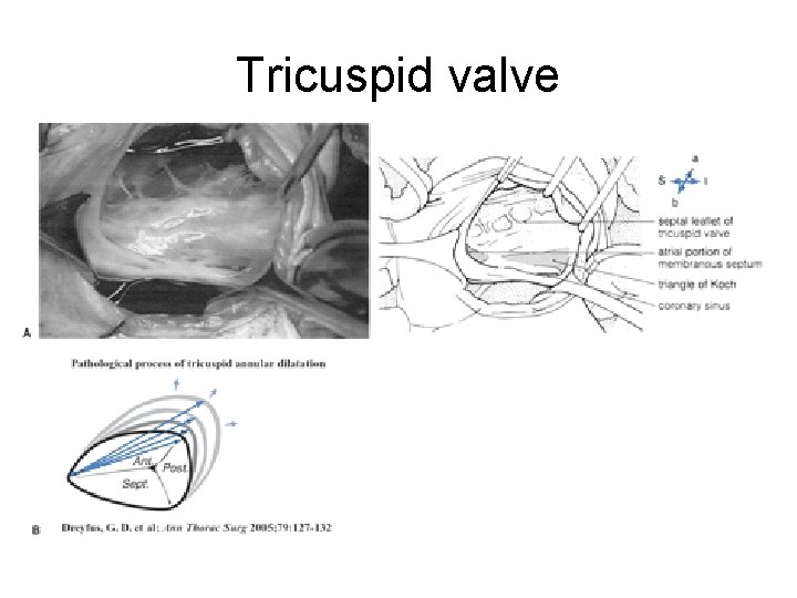 Tricuspid valve 