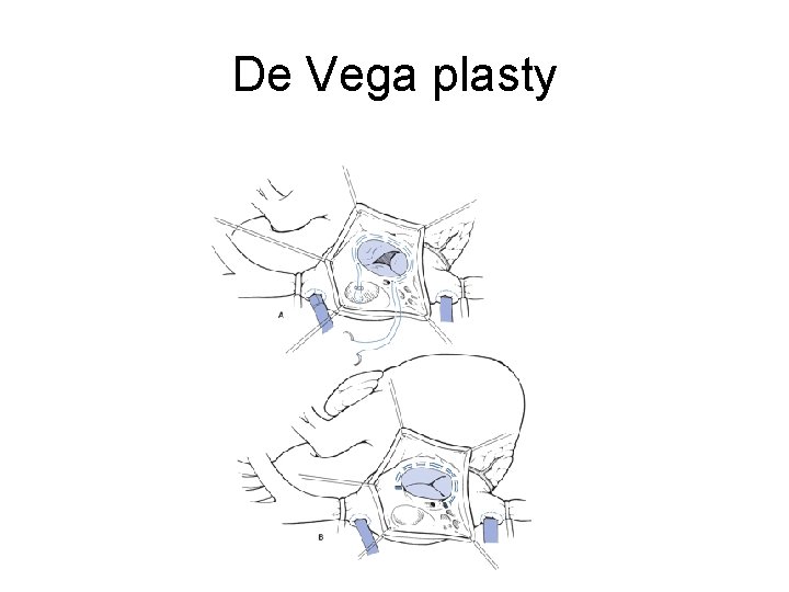 De Vega plasty 