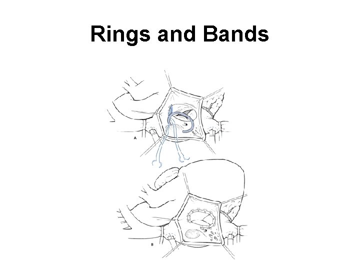 Rings and Bands 