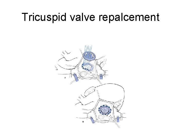 Tricuspid valve repalcement 