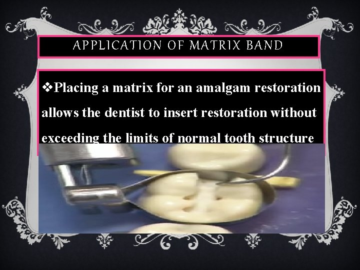 APPLICATION OF MATRIX BAND v. Placing a matrix for an amalgam restoration allows the