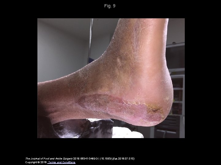 Fig. 9 The Journal of Foot and Ankle Surgery 2019 58341 -346 DOI: (10.