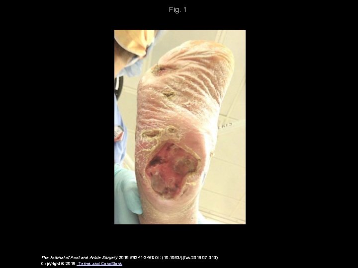 Fig. 1 The Journal of Foot and Ankle Surgery 2019 58341 -346 DOI: (10.