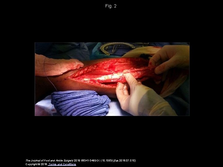 Fig. 2 The Journal of Foot and Ankle Surgery 2019 58341 -346 DOI: (10.