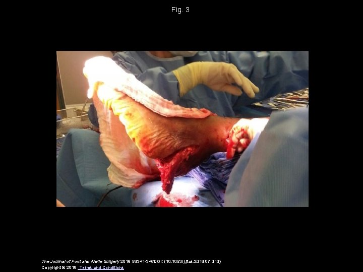 Fig. 3 The Journal of Foot and Ankle Surgery 2019 58341 -346 DOI: (10.