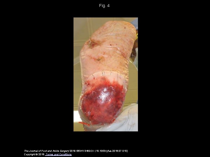 Fig. 4 The Journal of Foot and Ankle Surgery 2019 58341 -346 DOI: (10.