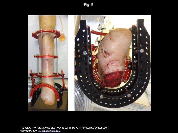 Fig. 5 The Journal of Foot and Ankle Surgery 2019 58341 -346 DOI: (10.