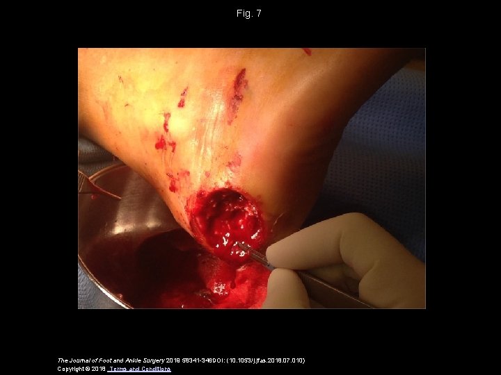 Fig. 7 The Journal of Foot and Ankle Surgery 2019 58341 -346 DOI: (10.