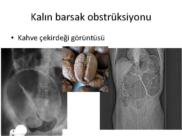 Kalın barsak obstrüksiyonu • Kahve çekirdeği görüntüsü 