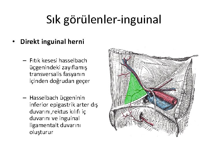 Sık görülenler-inguinal • Direkt inguinal herni – Fıtık kesesi hasselbach üçgenindeki zayıflamış transversalis fasyanın