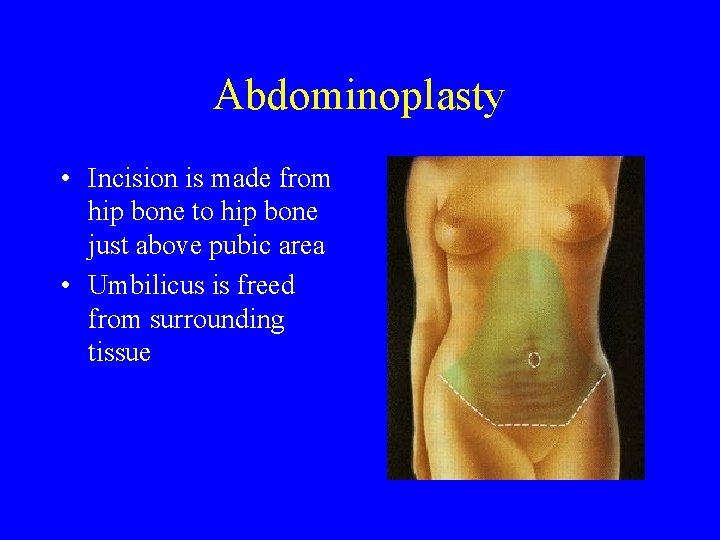  Abdominoplasty • Incision is made from hip bone to hip bone just above