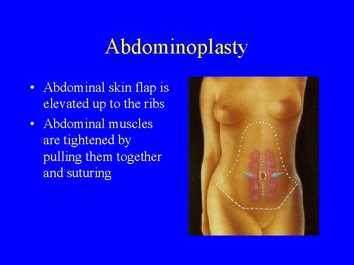  Abdominoplasty • Abdominal skin flap is elevated up to the ribs • Abdominal