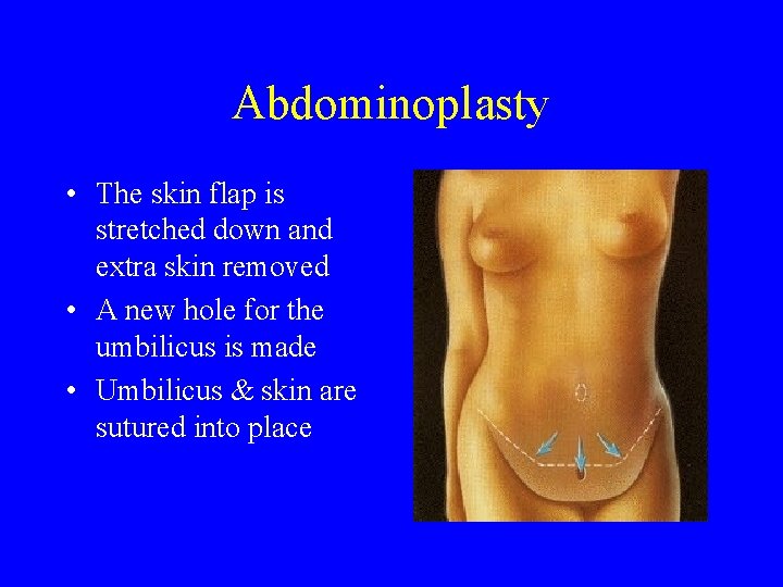  Abdominoplasty • The skin flap is stretched down and extra skin removed •