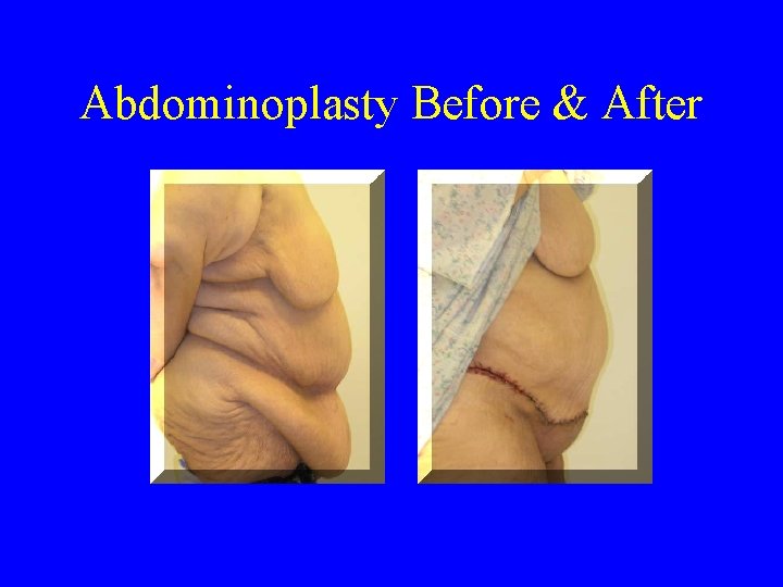 Abdominoplasty Before & After 