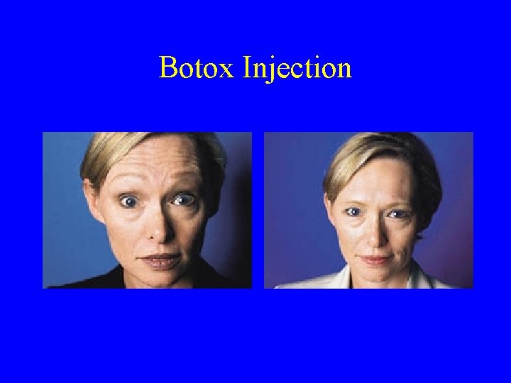 Botox Injection 