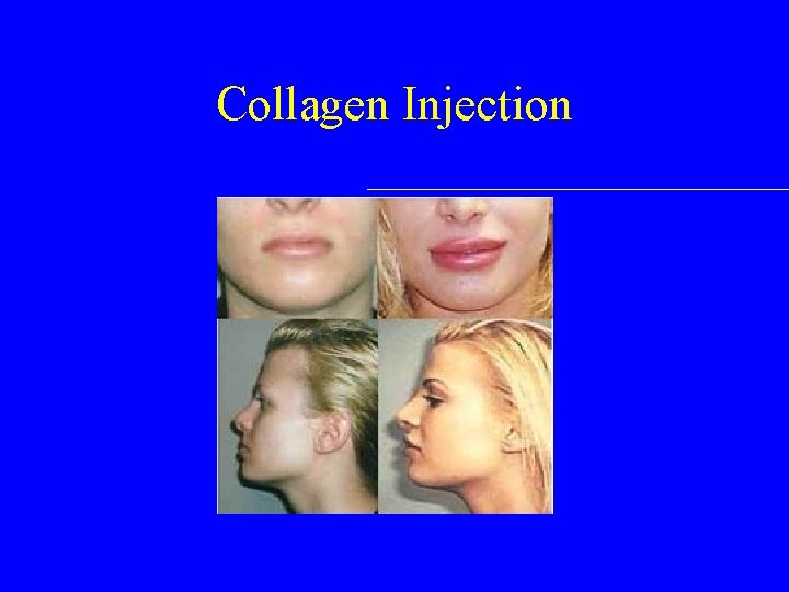 Collagen Injection 