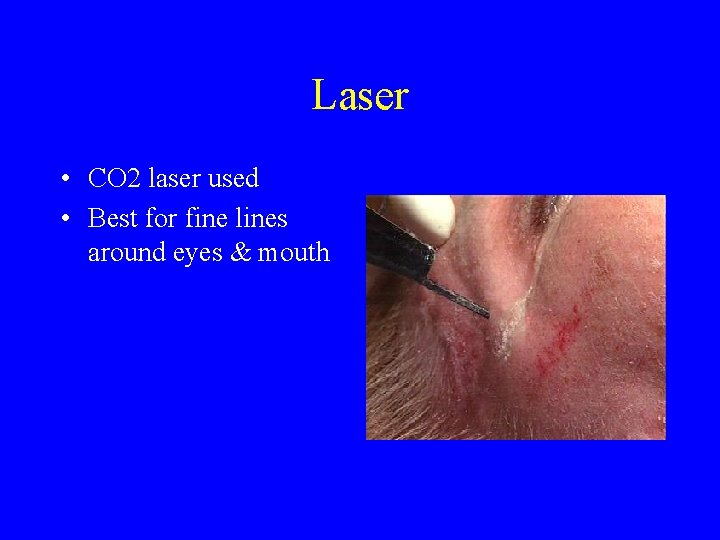 Laser • CO 2 laser used • Best for fine lines around eyes &