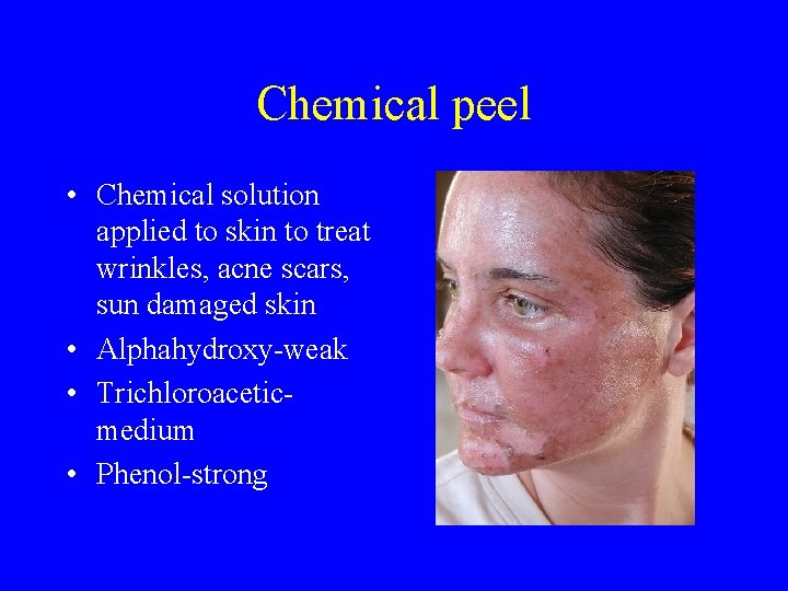 Chemical peel • Chemical solution applied to skin to treat wrinkles, acne scars, sun