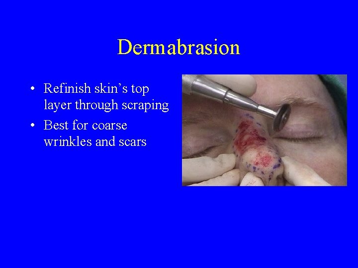 Dermabrasion • Refinish skin’s top layer through scraping • Best for coarse wrinkles and