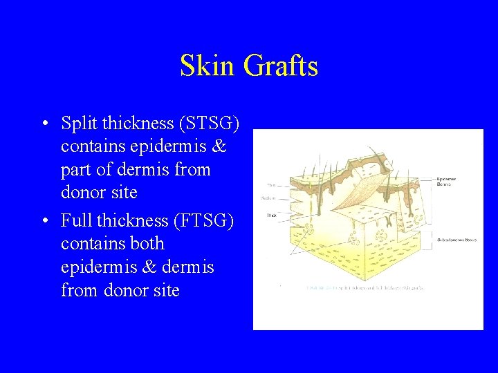 Skin Grafts • Split thickness (STSG) contains epidermis & part of dermis from donor