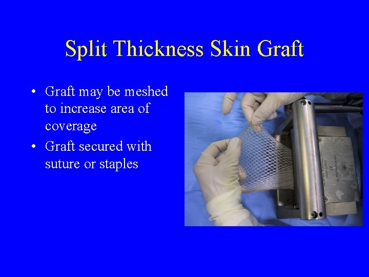 Split Thickness Skin Graft • Graft may be meshed to increase area of coverage