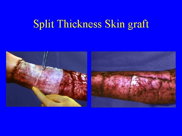 Split Thickness Skin graft 